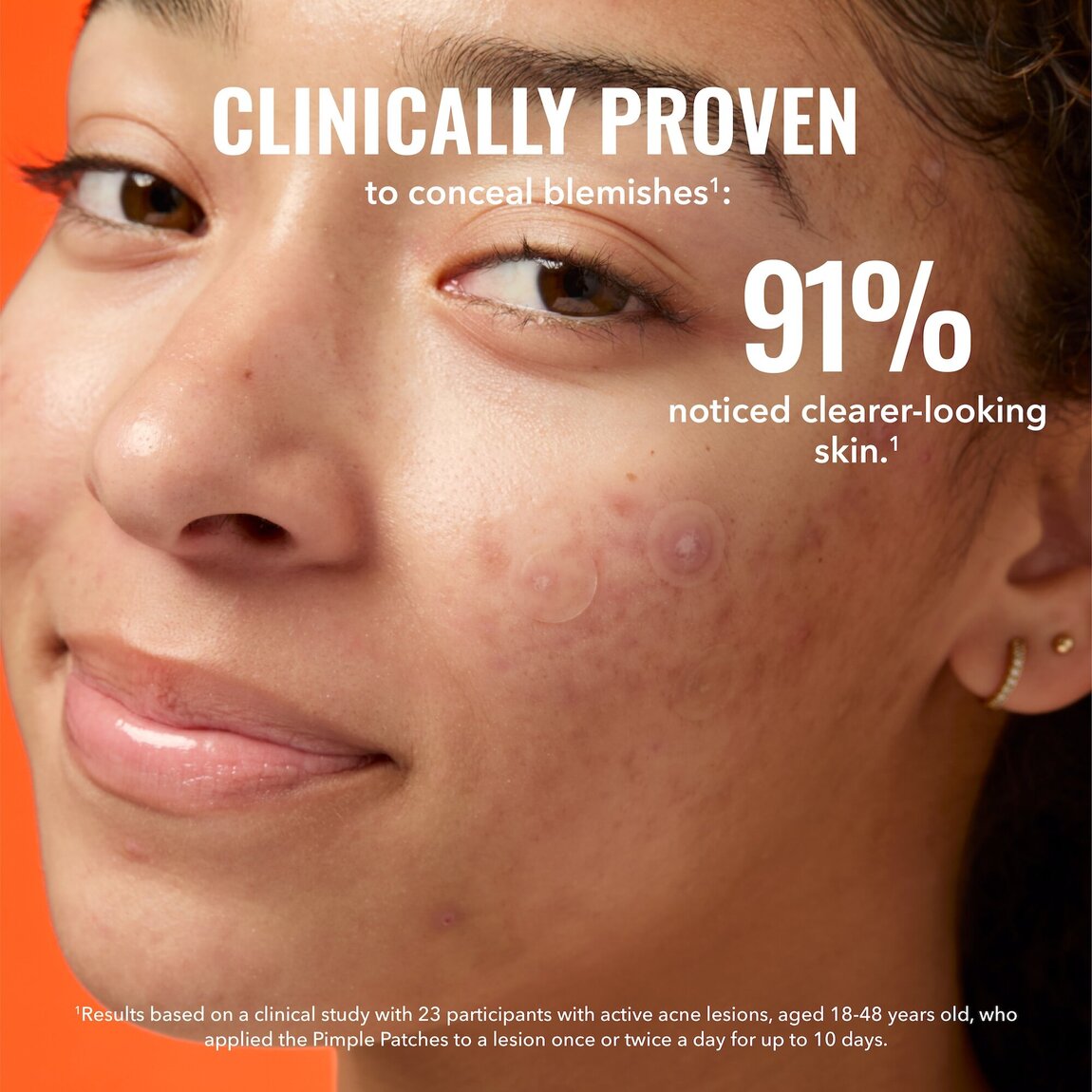 pimple-patches-d3 zb_p.jpg